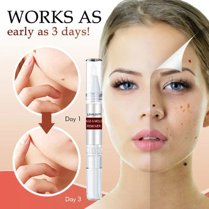 🎁Official Factory Direct Sales🎁Tags & Moles Remover