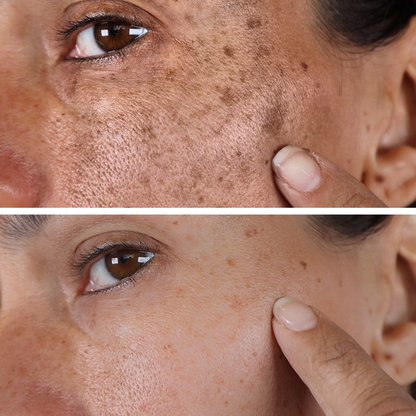Fast Dark Spot Remover-Melanin Correcting Brightening Serum