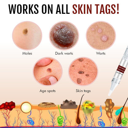🎁Official Factory Direct Sales🎁Tags & Moles Remover