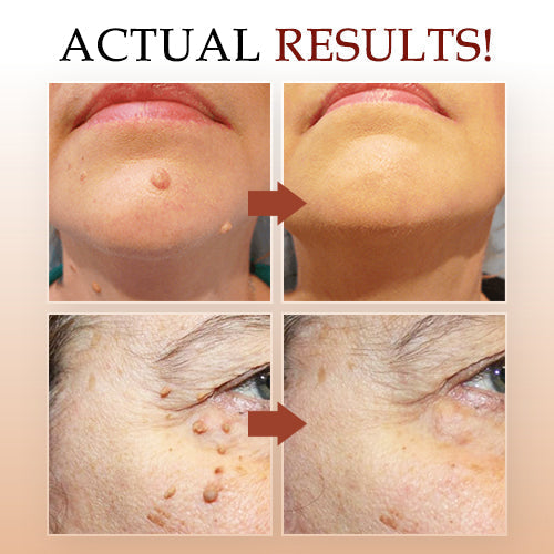 🎁Official Factory Direct Sales🎁Tags & Moles Remover